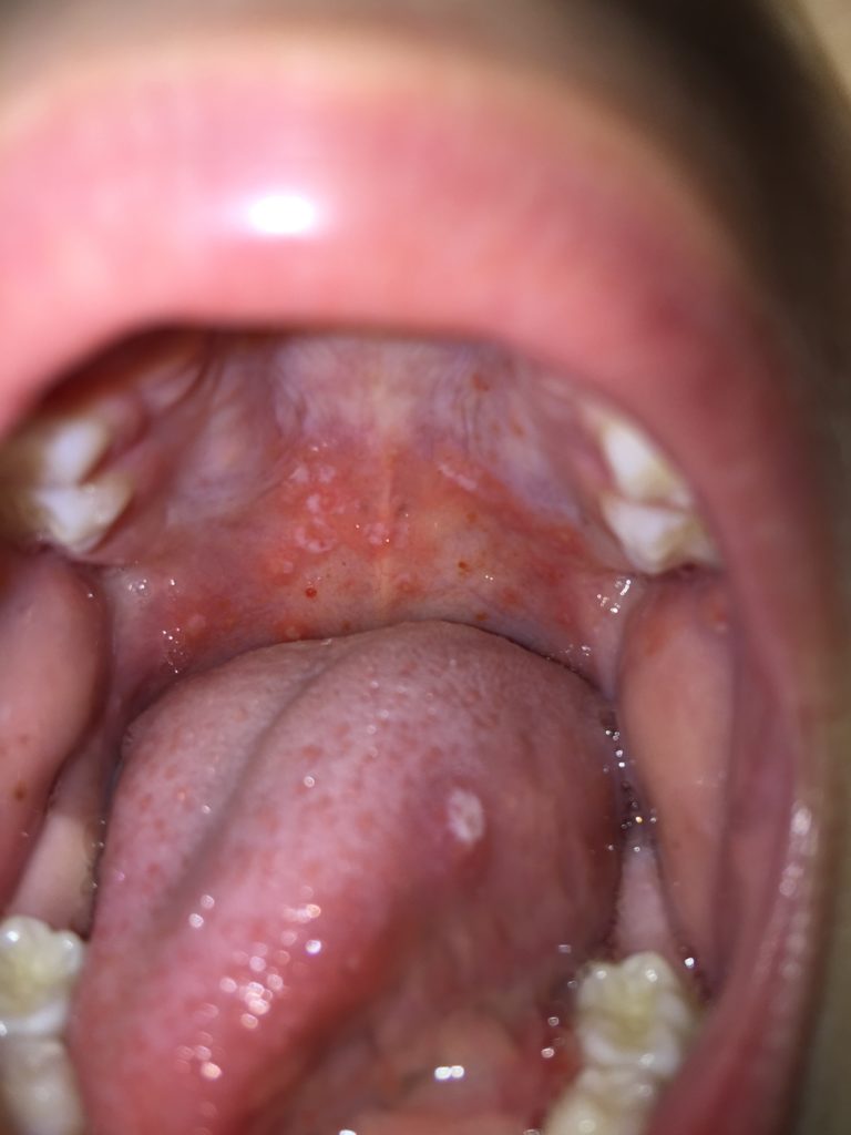 What Does Hand Foot And Mouth Disease Look Like In The Beginning